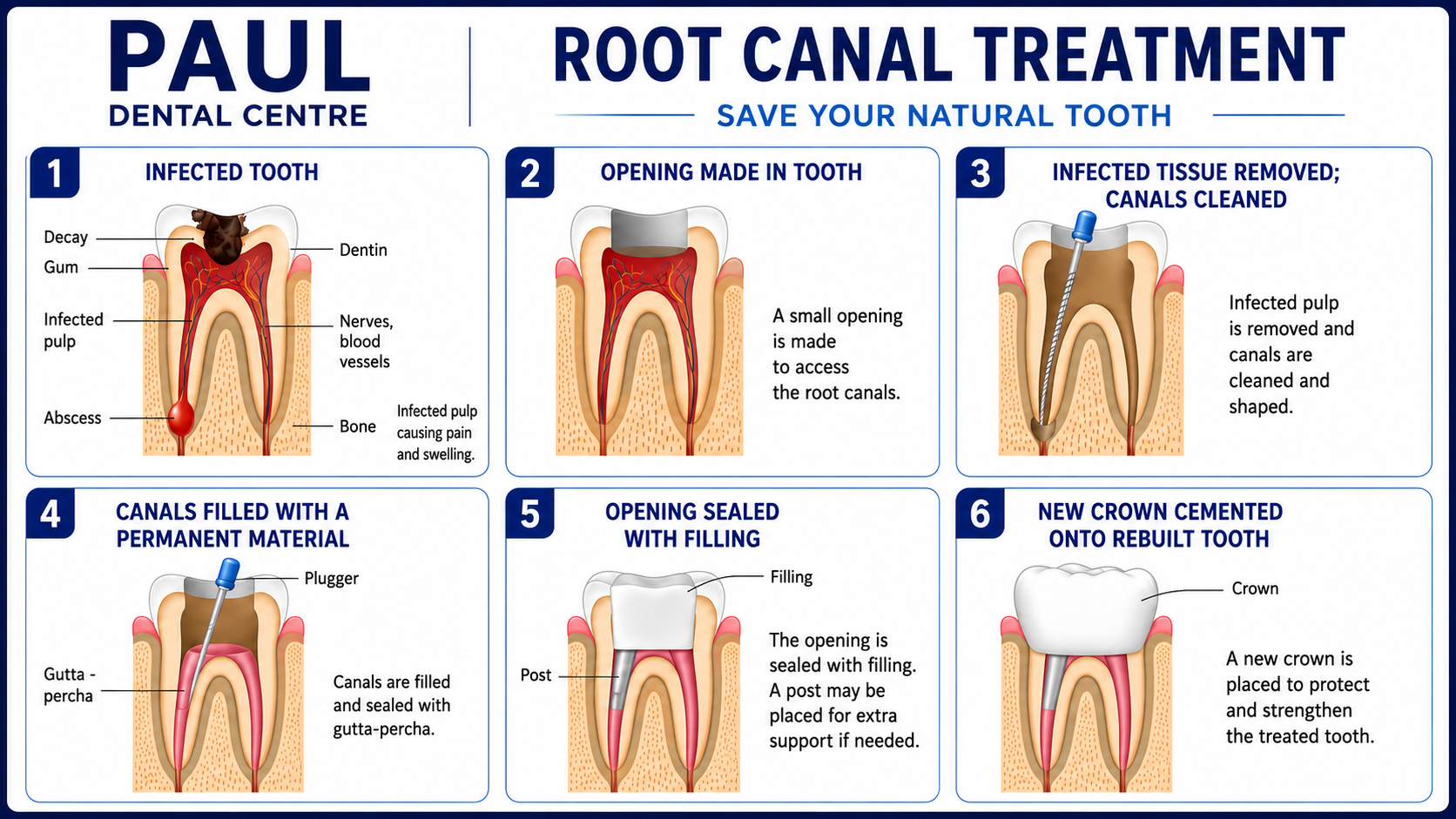 Preserving Your Natural Smile